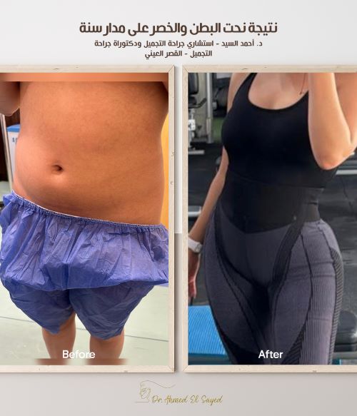 افضل دكتور نحت بطن في مصر